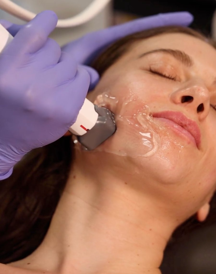 XERF radiofrequency applicator gliding across a gel-covered cheek