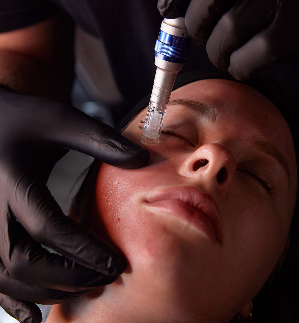 Microneedling Little Silver NJ