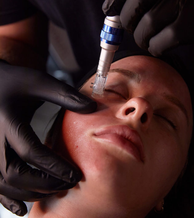 Microneedling Little Silver NJ